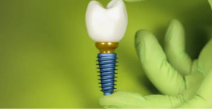dental implants Adelaide payment options
